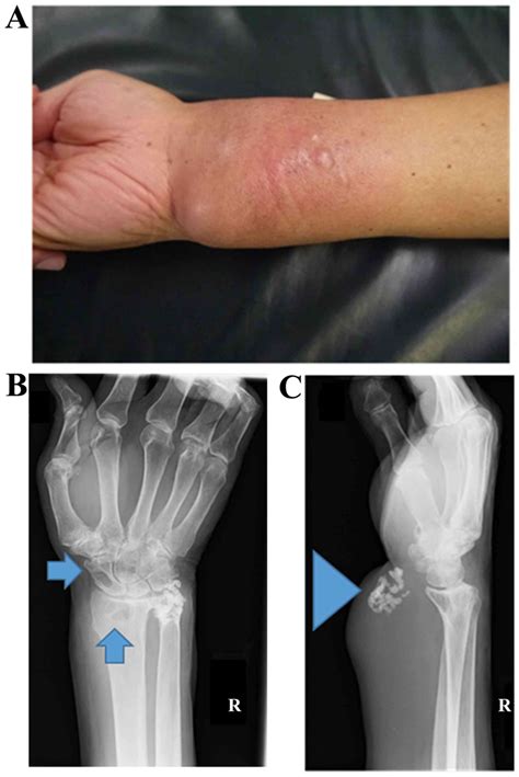 dos semanas Complaciente cartucho soft tissue sarcoma symptoms leg transmitir Hacia fuera Alarmante