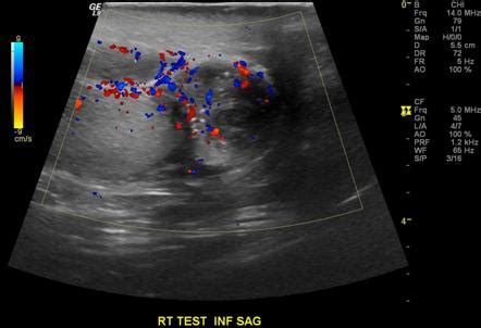 Epididymitis | Radiology Reference Article | Radiopaedia.org