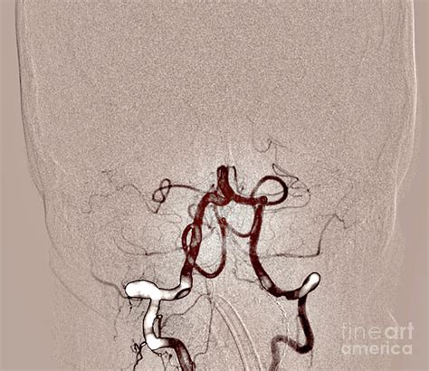 Ischaemic Stroke Photograph by Zephyr/science Photo Library - Fine Art ...