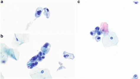 Atypical Urothelial Cells (AUC) | Basicmedical Key