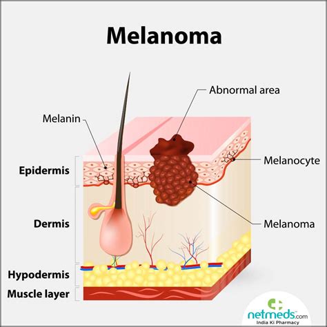 Melanoma: Causes, Symptoms And Treatment | Netmeds