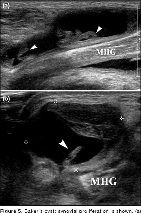 [PDF] Sonography of Baker’s Cyst (Popliteal Cyst): the Typical and ...