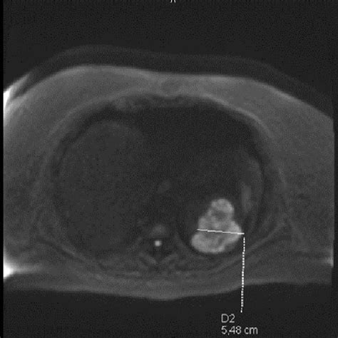 T2 weighted hyperintense lesion. | Download Scientific Diagram