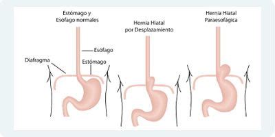 Hiatus Hernia Hiatal Hernia Types Of Hiatal Hernia Illustration Stock ...