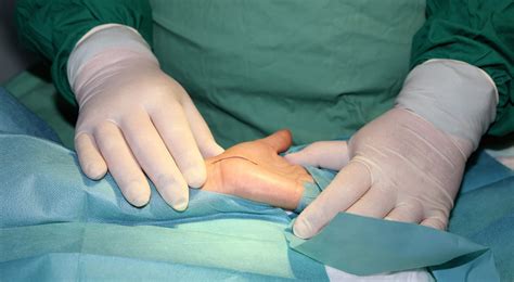 What You Need to Know About Carpal Tunnel Surgery Recovery Time ...