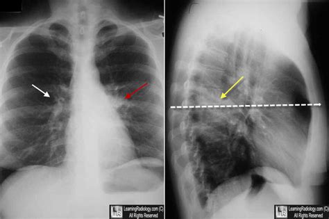 Learning Radiology - Dense Hilum Sign