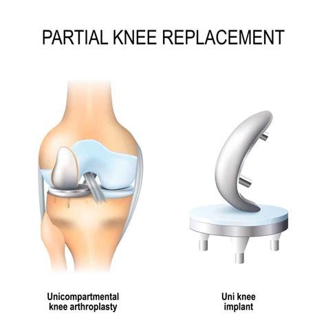 Knee Replacement Options | Total vs Partial | Spire Ortho