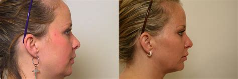 Neck Lift (Submentoplasty) Before and After Pictures Case 37 | Atlanta, Georgia | Buckhead ...