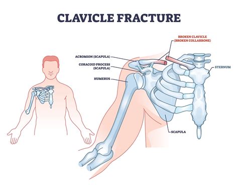 About Collarbone (Clavicle) Fractures | Dr. Kyle McClintock - Roseville, CA