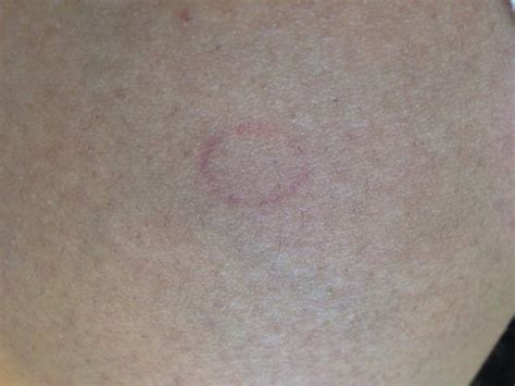 Perfect RED CIRCLE on thigh??? | BabyCenter