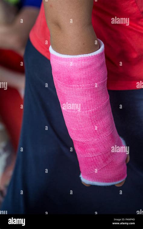 Photo of young girl and right arm is in pink cast. Model Release #114 Stock Photo - Alamy