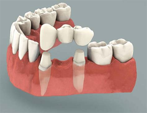 Dental Bridge - Procedure, Dental Bridge Vs Dental Implant