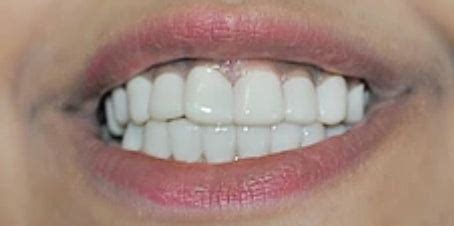 Press On Veneers Before and After - Photo Gallery – TruSmile Veneers