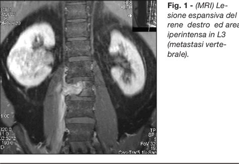 Figure 1 from Batson's Paravertebral Venous Plexus and Single Vertebral Metastases from Renal ...