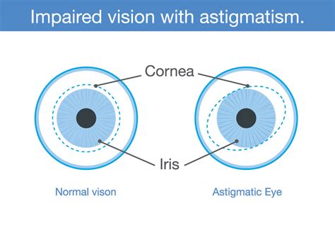 A Guide to All the Different Types of Contact Lenses You Can Wear ...