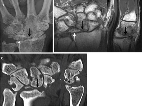 SLAC wrist with late radiological findings. Posteroanterior wrist ...