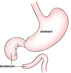 Intestinal Atresia and Stenosis | Treatment, Diagnosis, and Outlook