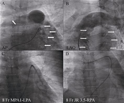 Angiogram relates to case 2. (A&B): Pulmonary artery angiogram showing... | Download Scientific ...