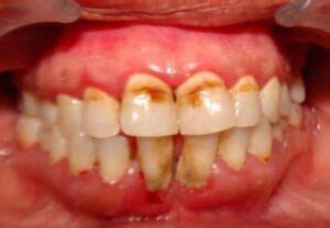 Mottled Teeth Causes, in Children, Treatment after Fluorosis