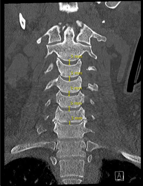 Subaxial Cervical Spine CT | Radiology Key