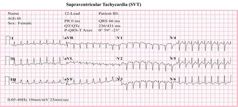 Atrial Tachycardia - Causes, Symptoms, Diagnosis, Treatment