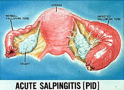 MEDICAL IMAGES: Acute salpingitis