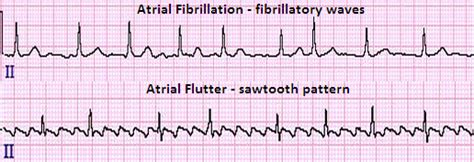 Pin on Atrial Flutter