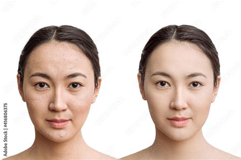 the concept of skin care before, after. young asian woman with bad skin ...