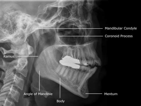 Radiographic Anatomy of Facial Bones and Mandible with Radiological ...