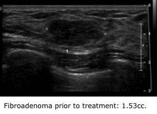 Using High-Intensity Focused Ultrasound to Treat Breast Fibroadenomas ...