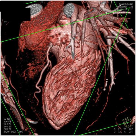 Normal Coronary CTA - Cardiac Case Studies - CTisus CT Scanning