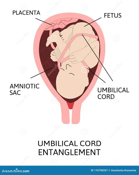 Umbilical Cord Entanglement. Vector Illustration of Entanglement of ...