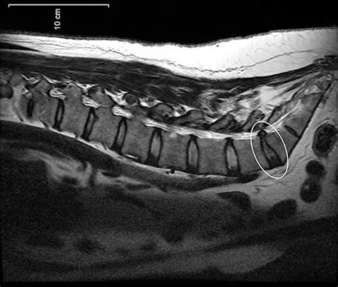 Understanding Your MRI Results For Lower Back Pain - Sport & Spinal Physiotherapy