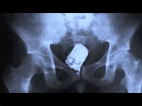 25 Strangest Things Found In An X-Ray | I'm in That Weird Part of ...