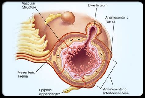 Diverticulitis (Diverticulosis) Pictures Slideshow - MedicineNet | Diverticulitis ...