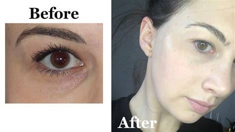 Tear Trough Filler Bruising - Healthy Anozo