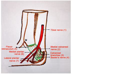 Tarsal Tunnel Syndrome—A New Way to Diagnose an Old Problem