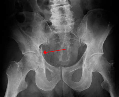 The Hip Bone - Ilium - Ischium - Pubis - TeachMeAnatomy