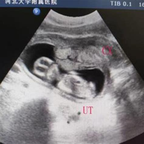 Ultrasonography of the retroverted gravid incarcerated uterus in the... | Download Scientific ...