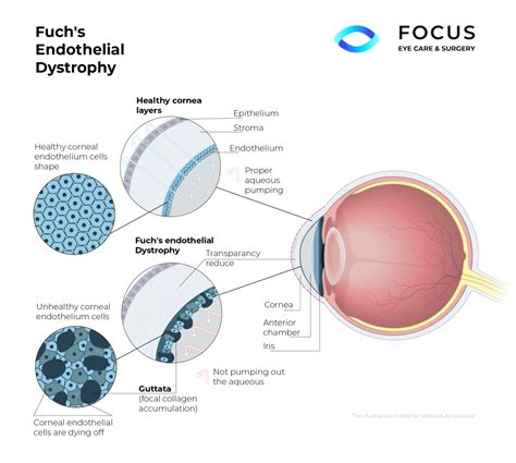 Fuchs Endothelial Dystrophy Queens NYC Long Island NY