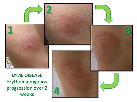 lyme-disease-rash-progression | On Landscape