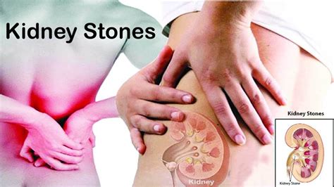 Kidney Stones – Prevention, Home Remedies, Herbal Treatment & Post treatment advice - Hakeem ...