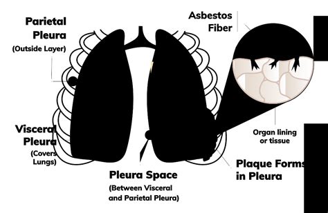 Pleural Mesothelioma | Treatment, Prognosis & Survival