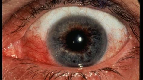 The Red Eye in the Rheumatology Patient | 1RheumNow