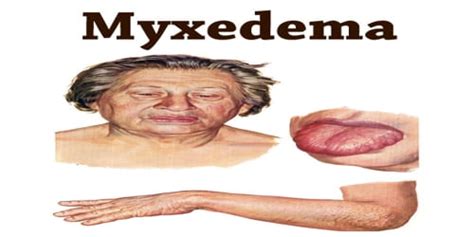 Myxedema - Assignment Point