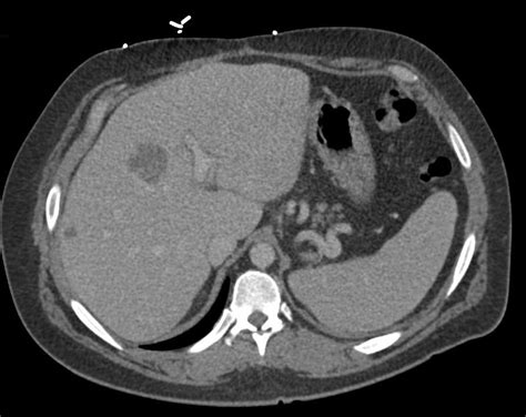 Liver Metastases from Colon Cancer - Liver Case Studies - CTisus CT Scanning