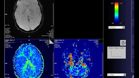 Perfusion MRI - YouTube