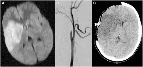 MRI diffusion-weighted images demonstrating restricted diffusion in the ...