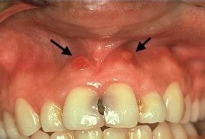 Canker Sore in Mouth (Tongue, Lips and Gums) - Pictures, Causes and ...