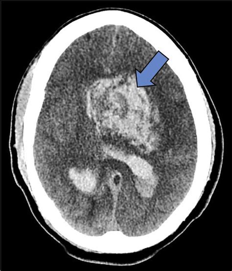 Large Intracerebral Hemorrhage With Ventricular Extension and Vasogenic... | Download Scientific ...